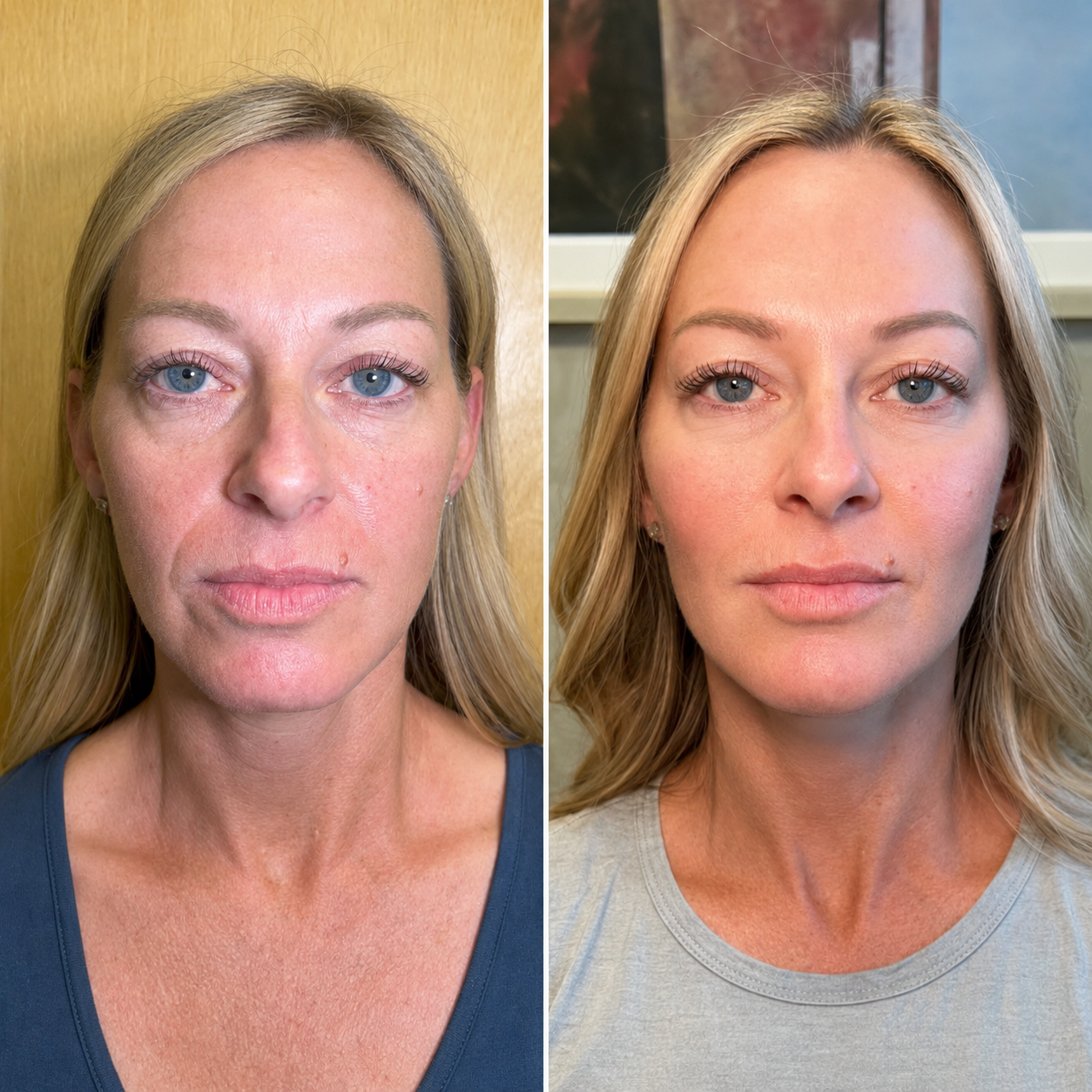 Volufiline 100% Ampoule