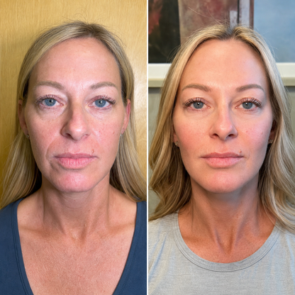 Volufiline 100% Ampoule